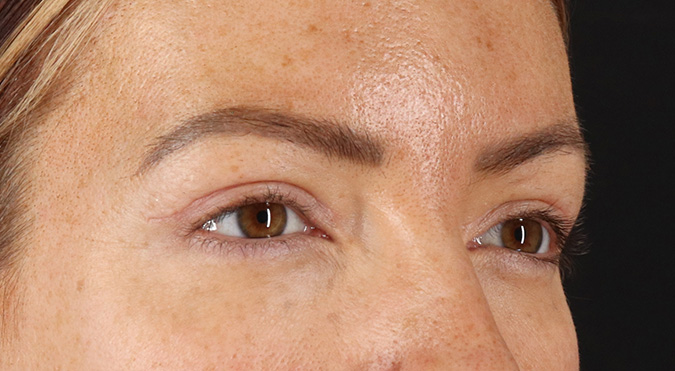 After - right_oblique