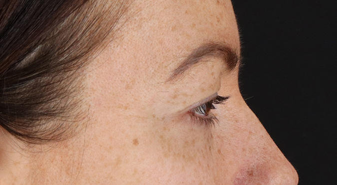 Before - right_lateral