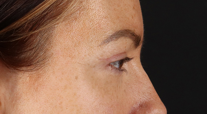 After - right_lateral