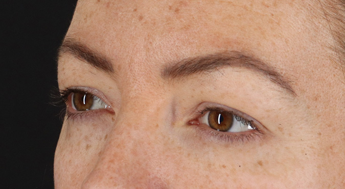 Before - left_oblique