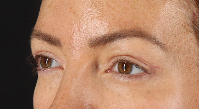 After - left_oblique