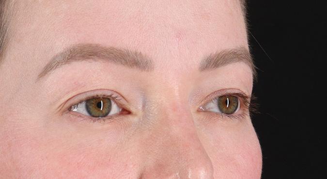 Before - right_oblique