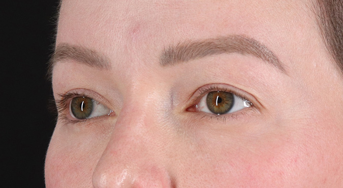 Before - left_oblique