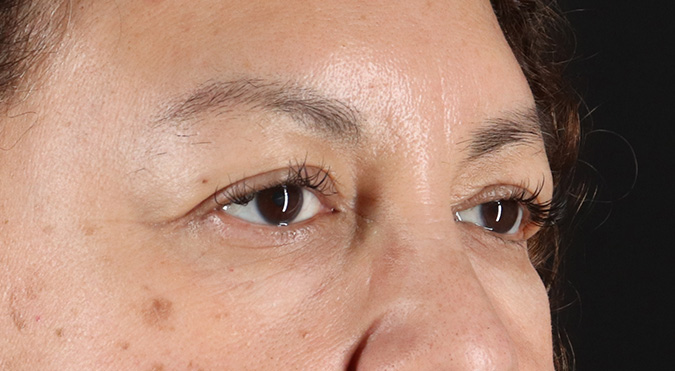 Before - right_oblique