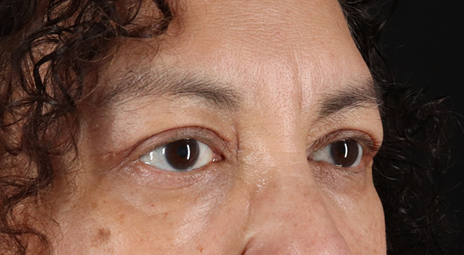 After - right_oblique