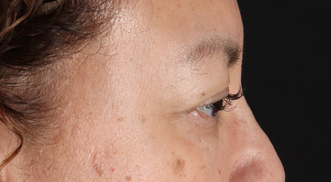 Before - right_lateral