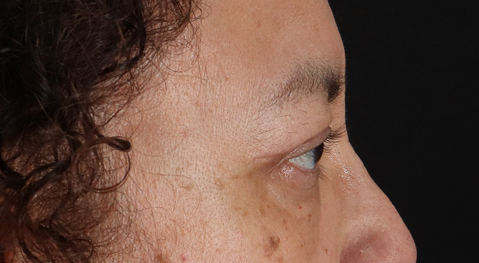 After - right_lateral