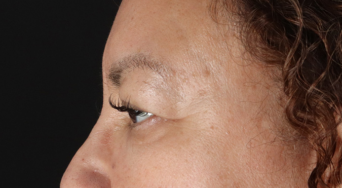 Before - left_lateral