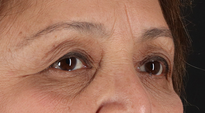 Before - right_oblique