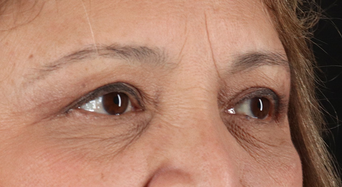 After - right_oblique