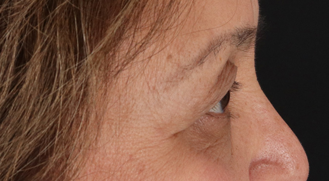 Before - right_lateral