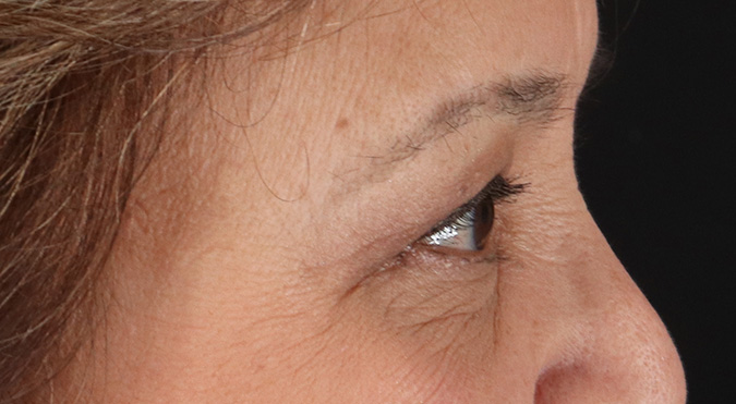 After - right_lateral