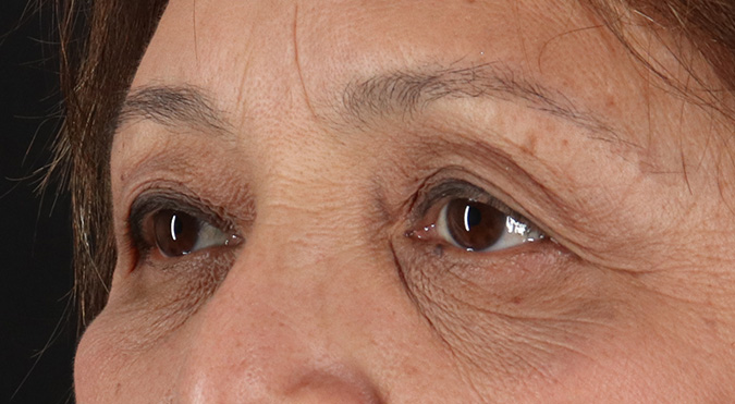 Before - left_oblique