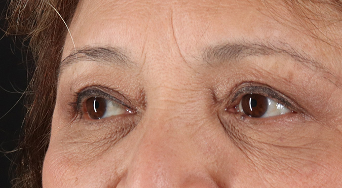 After - left_oblique