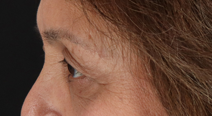 Before - left_lateral