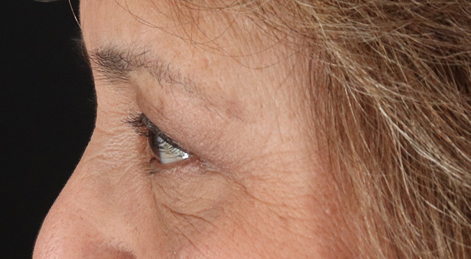 After - left_lateral