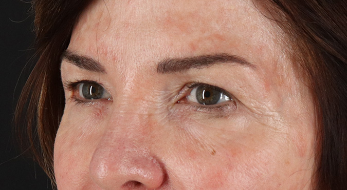 Before - left_oblique