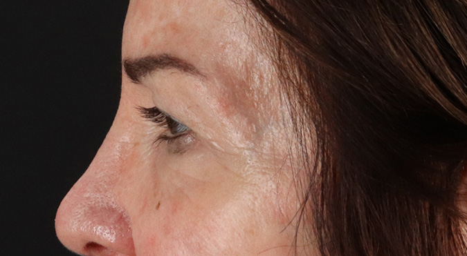 Before - left_lateral