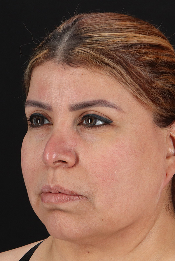 Before - left_oblique