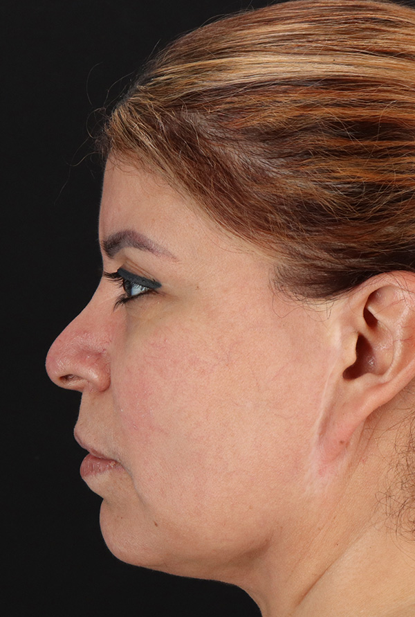 Before - left_lateral