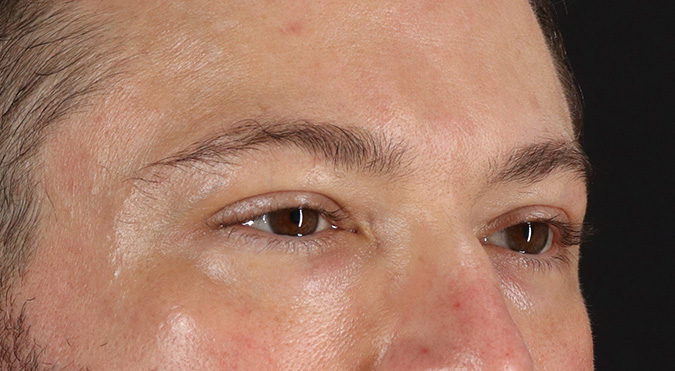 Before - right_oblique