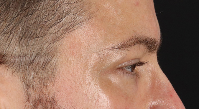 Before - right_lateral