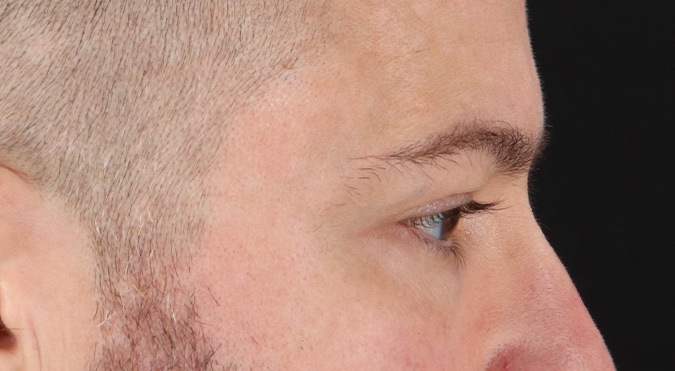 After - right_lateral