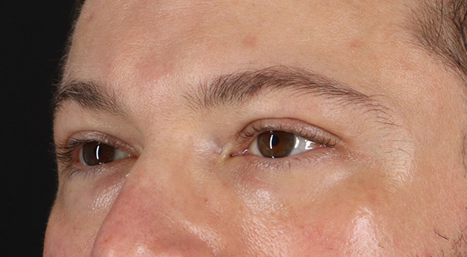 Before - left_oblique