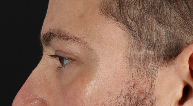 Before - left_lateral