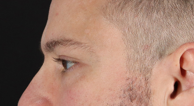 After - left_lateral