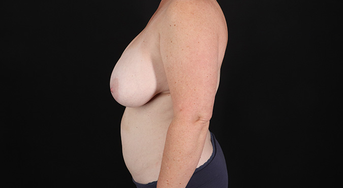 Before - left_lateral