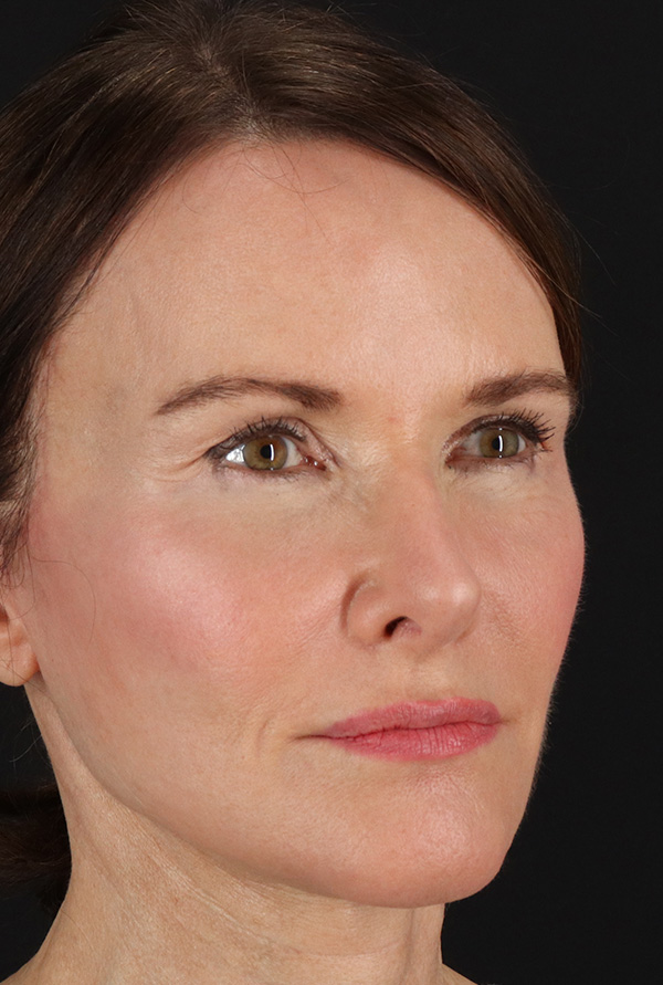 After - right_oblique