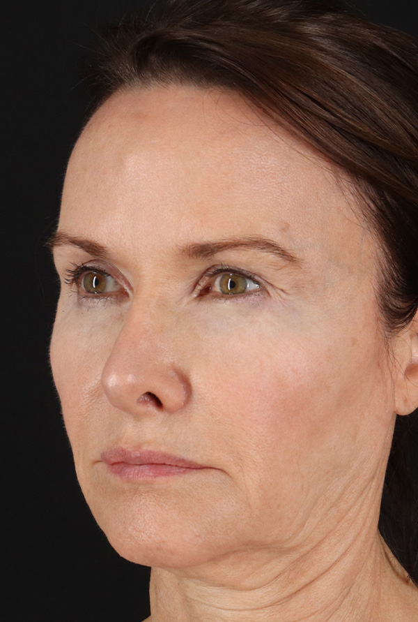 Before - left_oblique