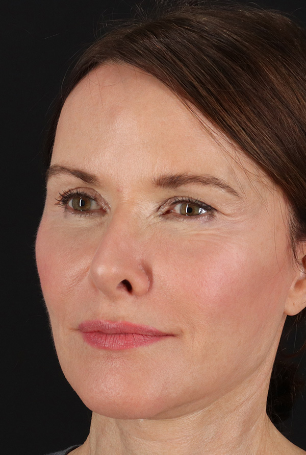 After - left_oblique