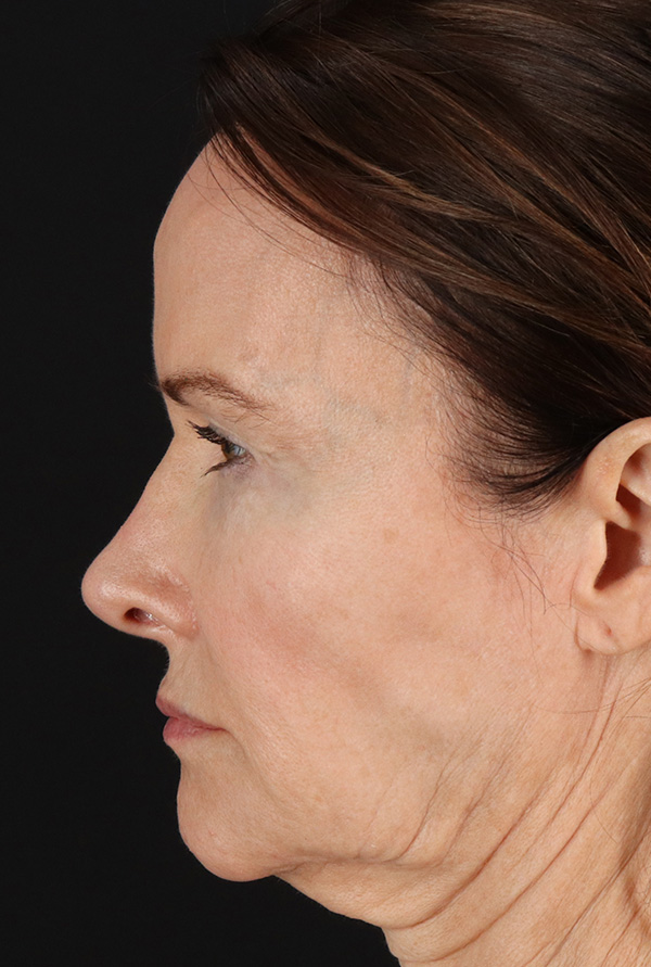 Before - left_lateral