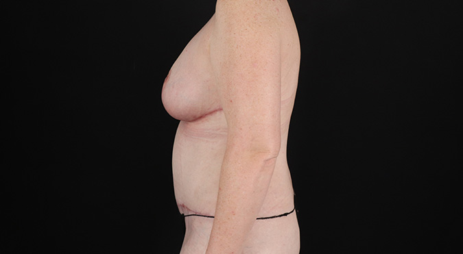 After - left_lateral