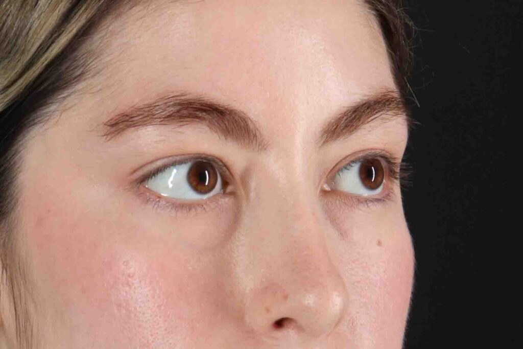 Before - right_oblique