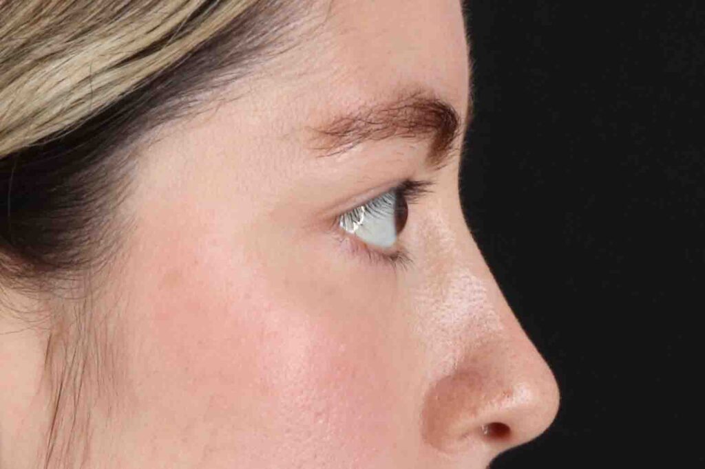 Before - right_lateral