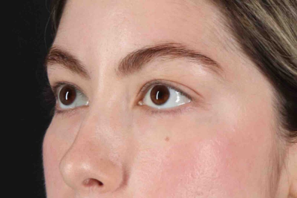 Before - left_oblique