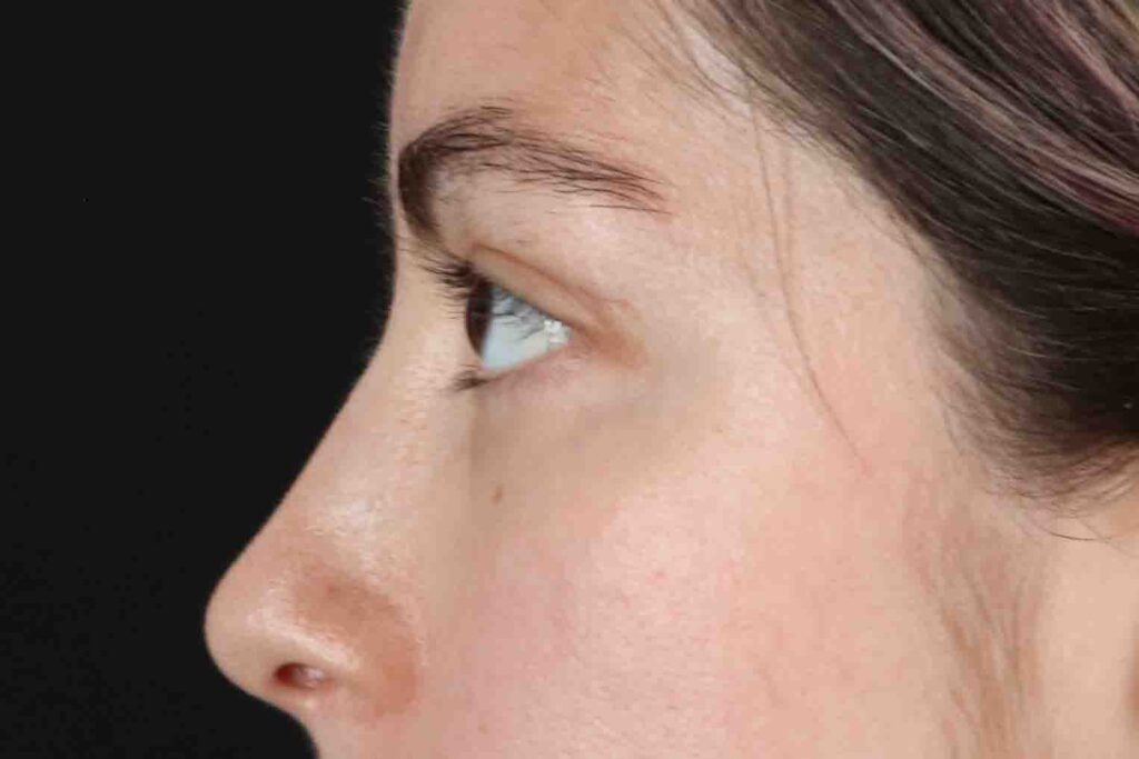 After - left_lateral