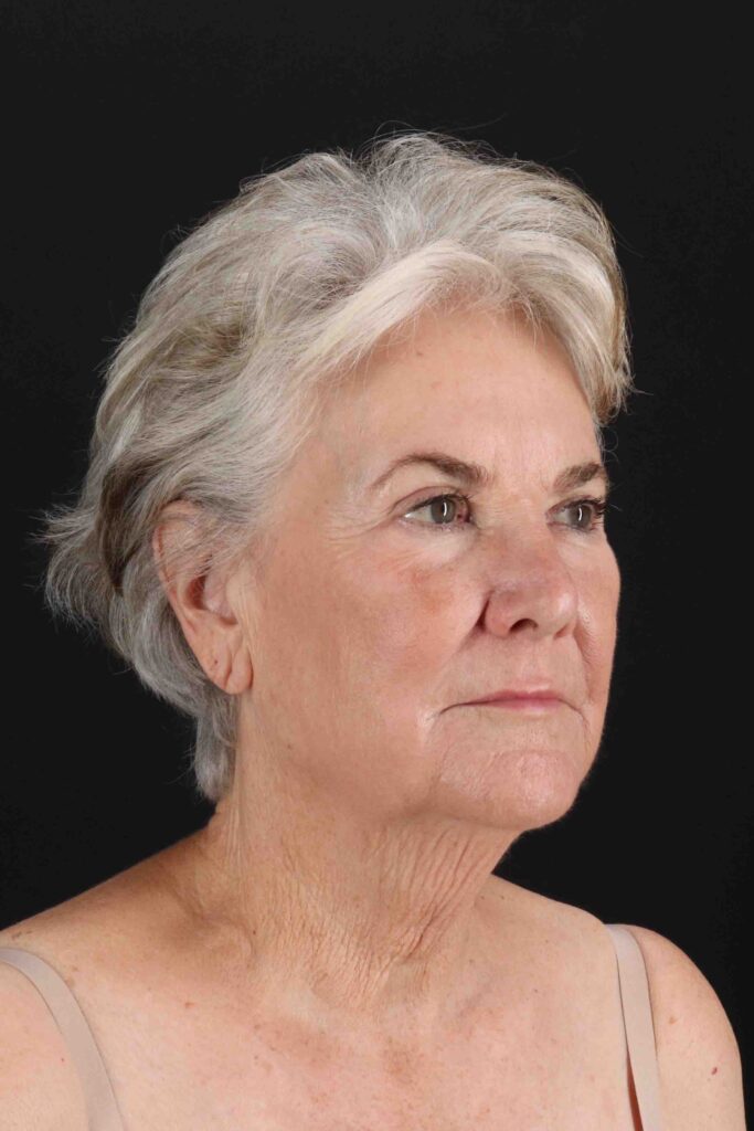 Before - right_oblique