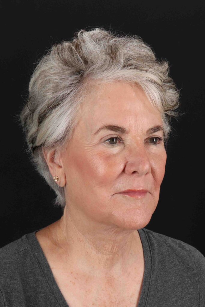 After - right_oblique