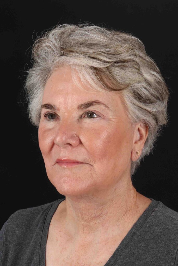 After - left_oblique