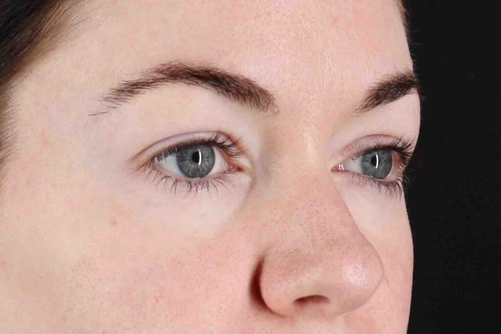 Before - right_oblique