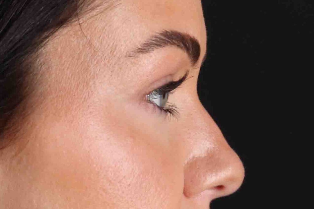 After - right_lateral