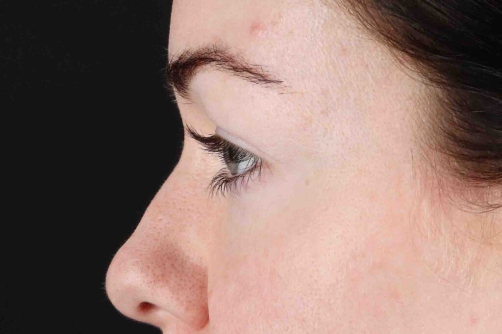 Before - left_lateral