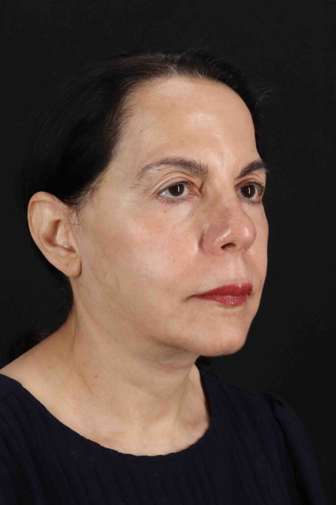 After - right_oblique