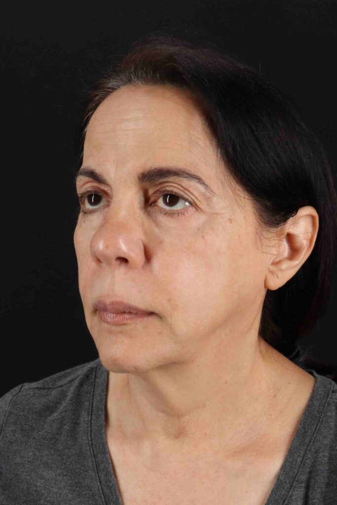 Before - left_oblique