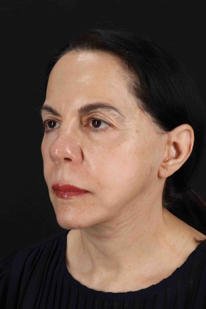 After - left_oblique