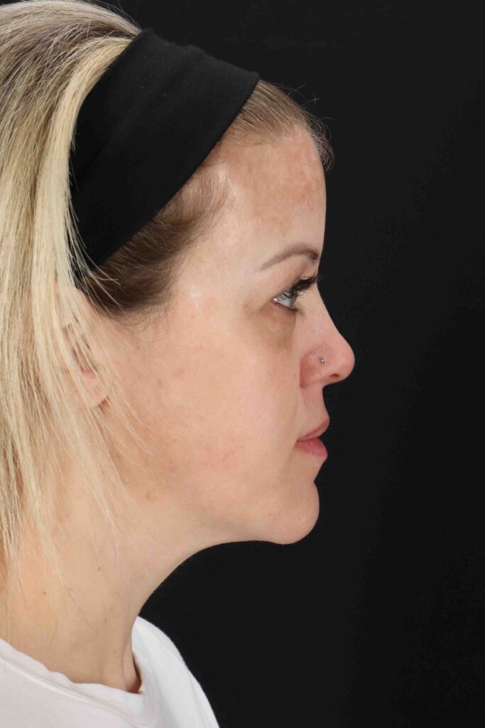 Before - right_lateral